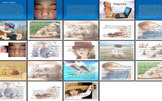 Juvenile Dermatomyositis A Case Report and Comprehensive Analysis