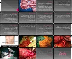دانلود پاورپوینت آپاندیسیت اپیدمیولوژی، پاتوفیزیولوژی، تظاهرات بالینی، تشخیص، عوارض و درمان