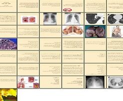 دانلود پاورپوینت اختلالات تنفسی COPD، ARF و ARDS