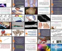 دانلود پاورپوینت شکستگی استخوان انواع، علائم، کمک های اولیه و اقدامات ضروری
