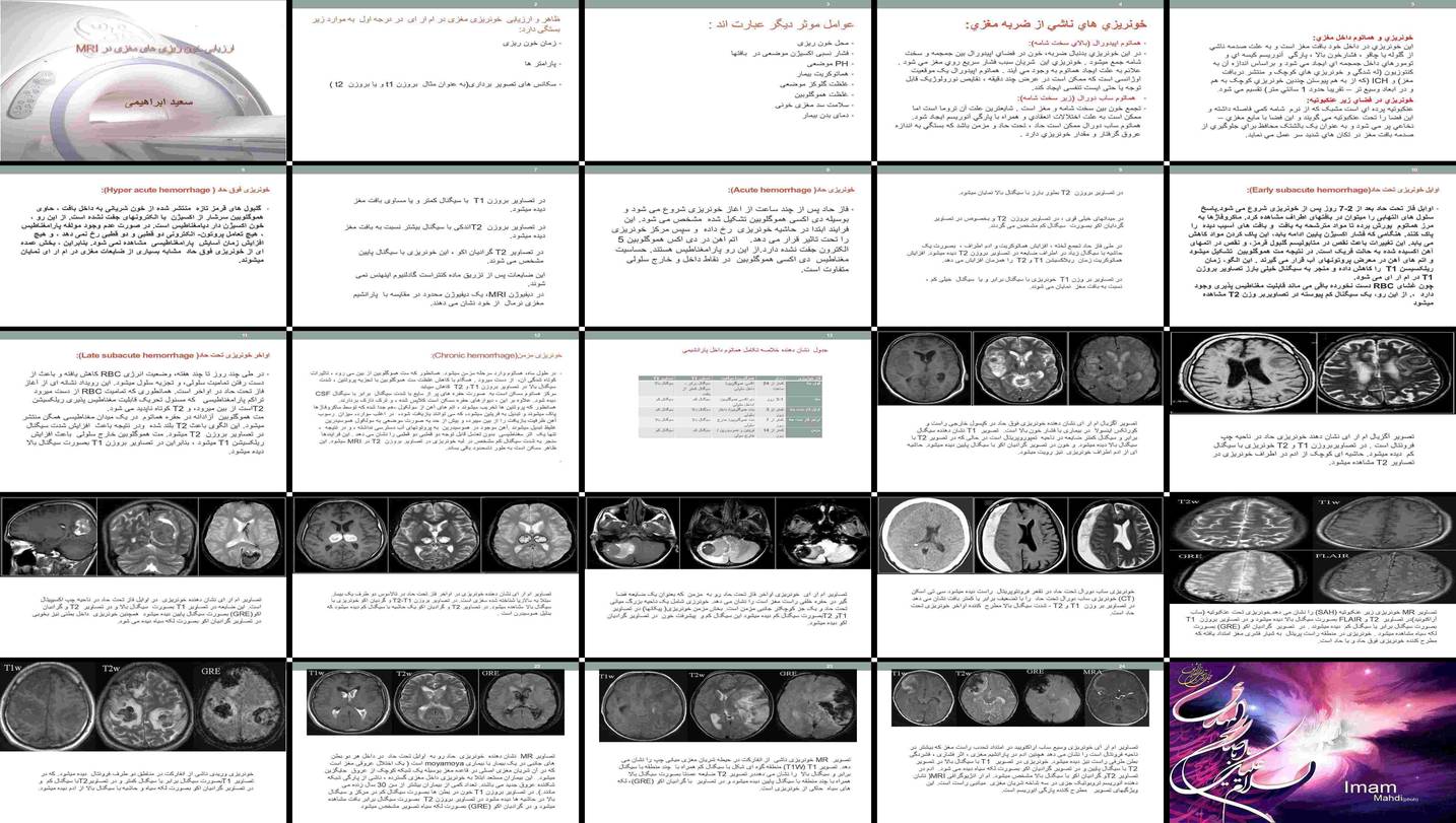 دانلود پروژه بررسی و ارزیابی خونریزی مغزی در MRI بر اساس زمان و محل