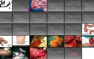 دانلود پروژه بررسی و تحلیل آپاندیسیت حاد اپیدمیولوژی پاتوفیزیولوژی تظاهرات بالینی درمان و