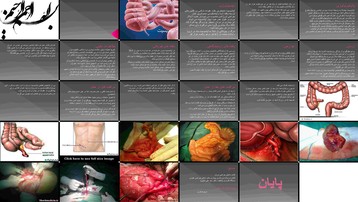 دانلود پروژه بررسی و تحلیل آپاندیسیت حاد اپیدمیولوژی پاتوفیزیولوژی تظاهرات بالینی درمان و دانلود پروژه بررسی و تحلیل آپاندیسیت حاد اپیدمیولوژی پاتوفیزیولوژی تظاهرات بالینی درمان و