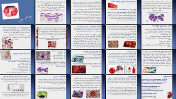 دانلود پروژه بررسی و تحلیل نقش چای سبز در درمان سرطان خون (لوسمی)