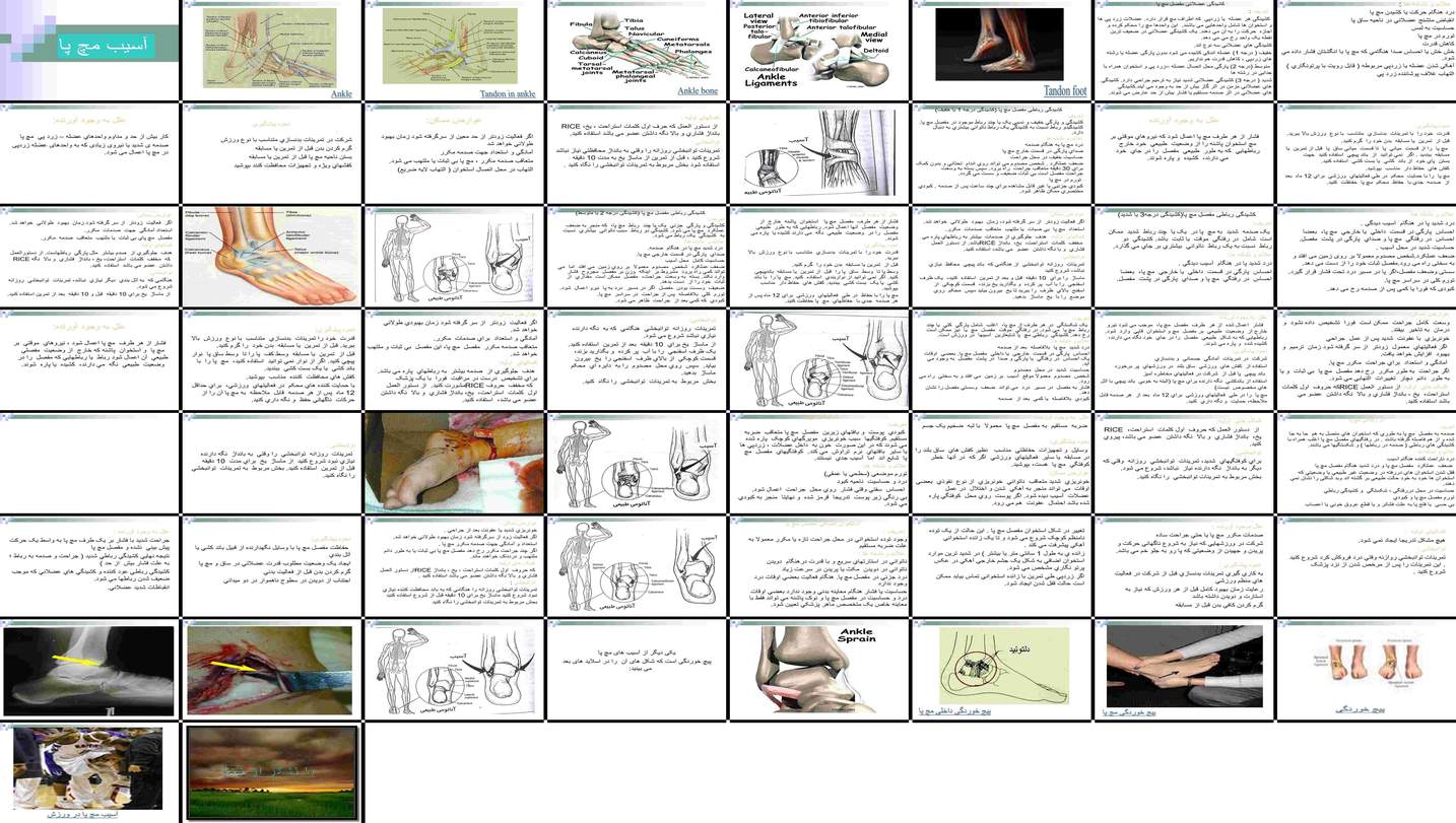 دانلود پروژه بررسی و تحلیل کشیدگی و شکستگی مفصل مچ پا علل پیشگیری و